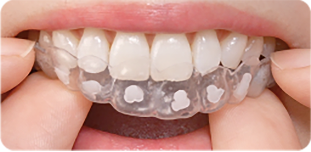 歯科医院の指導でホームホワイトニング