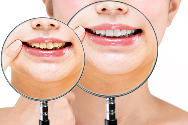 ホワイトニングで白くなった歯 前後イメージ